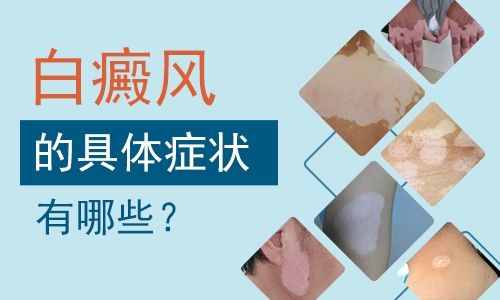 穩(wěn)定期的白癜風(fēng)有哪些主要的癥狀